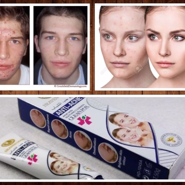 New Anti Acne Cream Clean Pox Soothing Cleanser (daane wagera saaf karta hai chehre se)